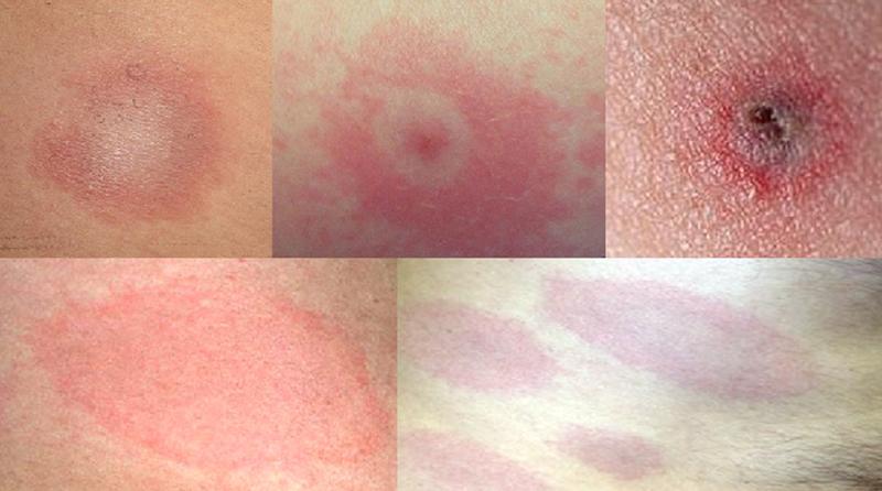 Objawy rumienia kleszczowego