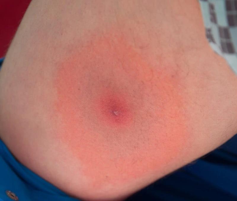 Powikłania po ukąszeniu kleszcza