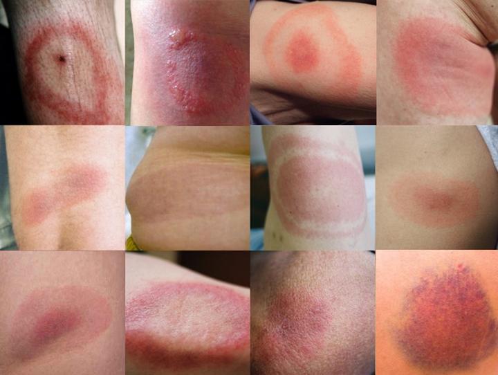 Rumień po kleszczu – objawy, które warto znać, by uniknąć groźnych powikłań
