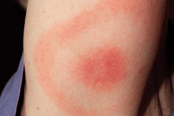 Co warto wiedzieć o zmianach skórnych po kleszczu: objawy i ryzyko boreliozy